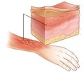 Damage Control Surgery в хирургии ожогов при комбинированных огнестрельных повреждениях