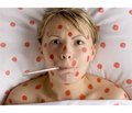 Нетипичный случай заболевания корью у пациента старшего возраста (привитого) с осложнениями со стороны нервной системы
