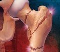 Роль количества и качества костной ткани в риске развития переломов при остеопорозе