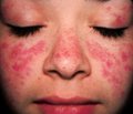Condition of vascular wall and endothelial function in children with systemic lupus erythematosus