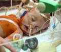 Markers of unfavorable course of bronchopulmonary dysplasia in children at the present stage